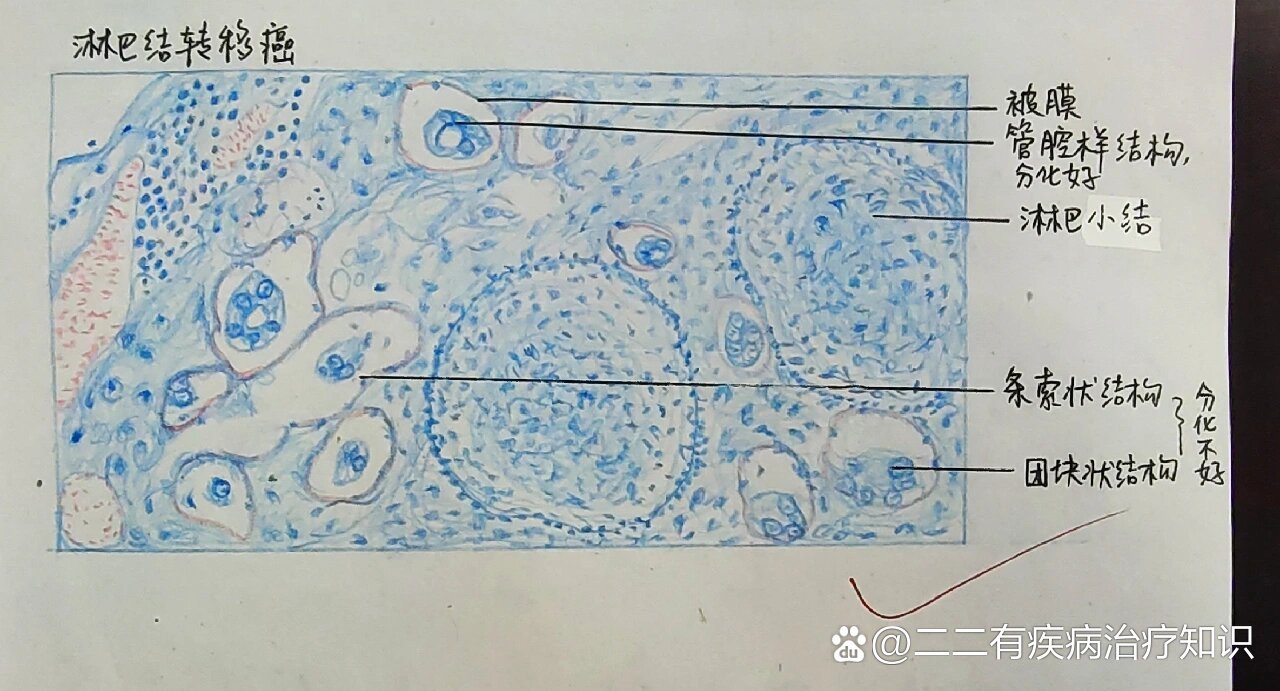 病理学实验绘图——淋巴结转移癌