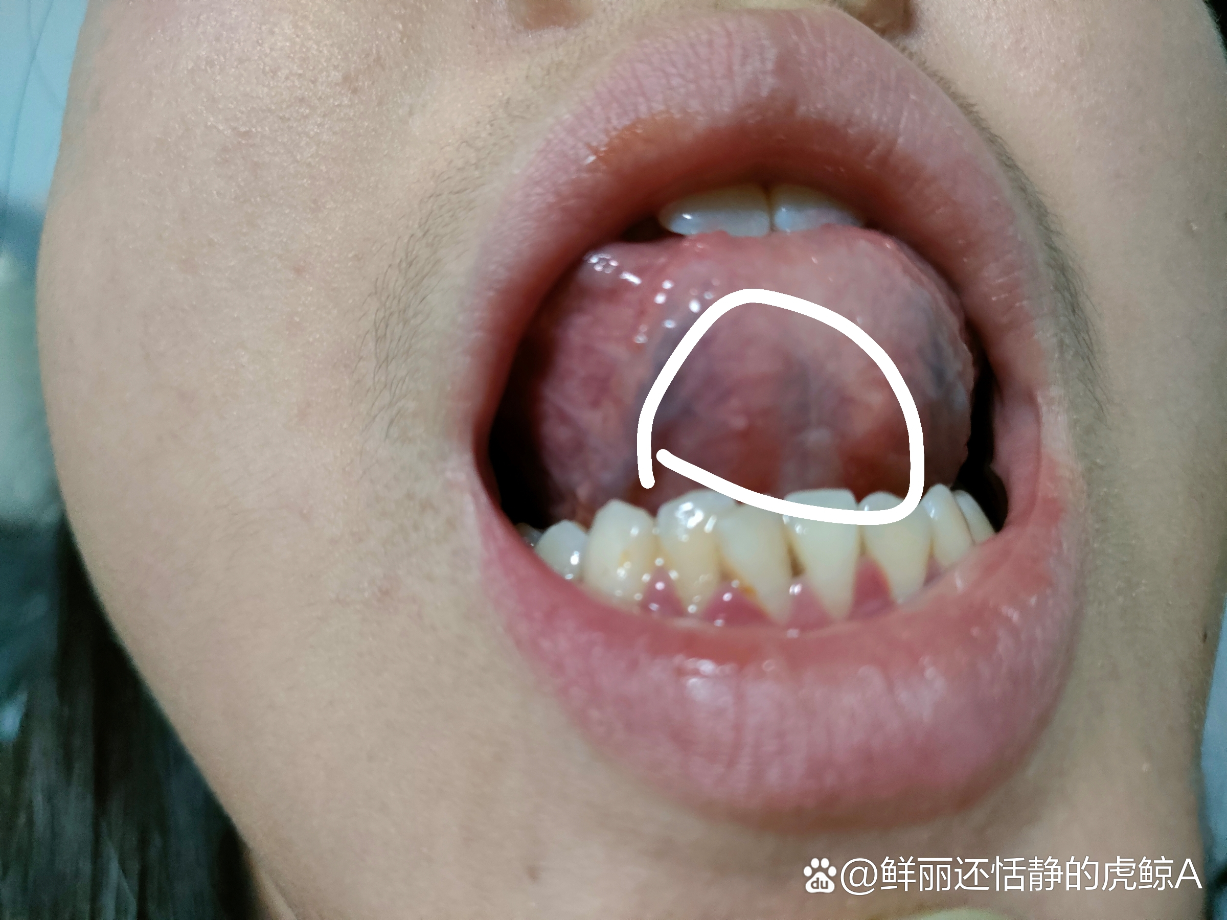 我想知道这个是不是感染了hpv?