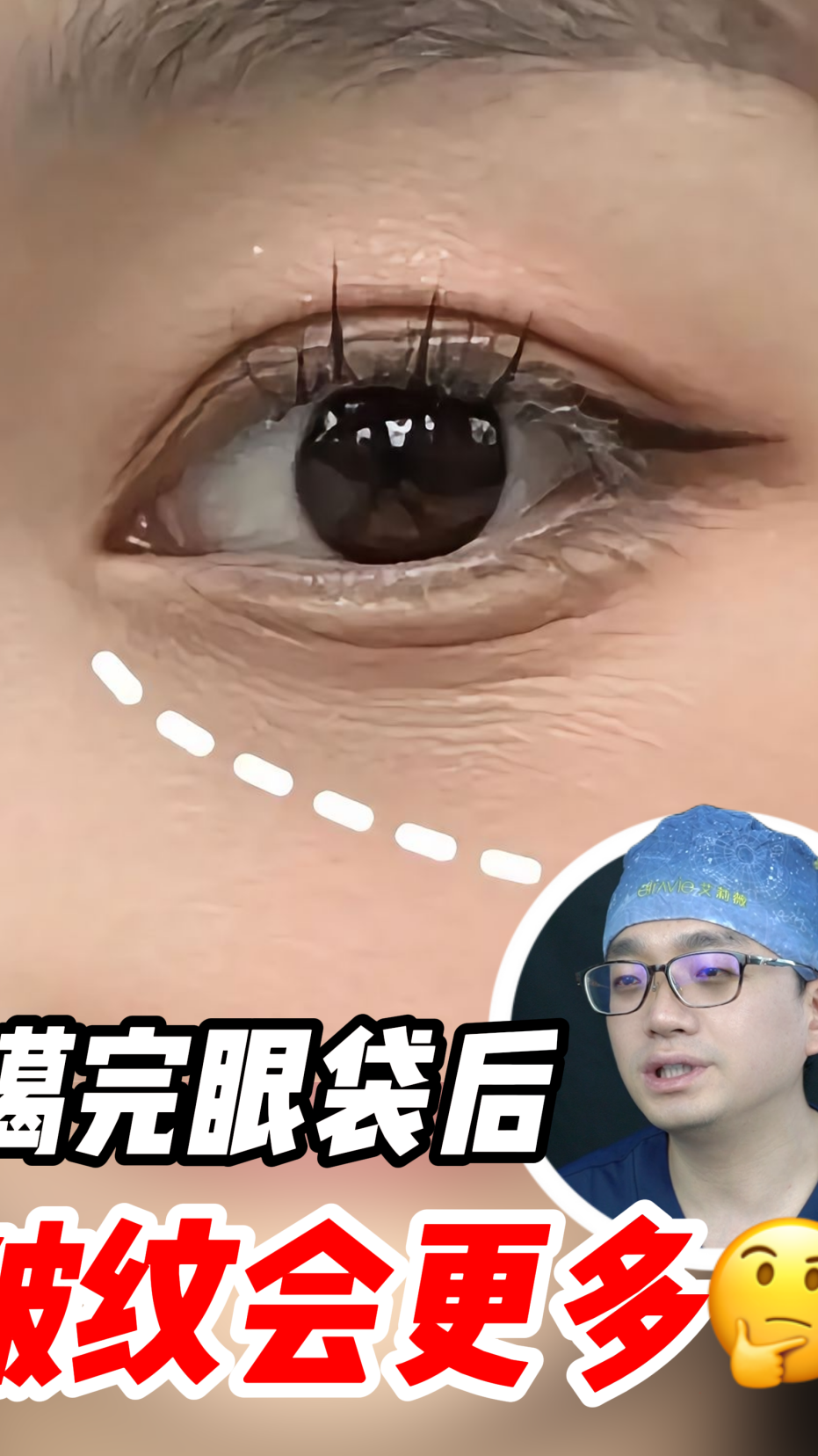 眼袋手术后皱纹会更多?很多人都忽略了这个