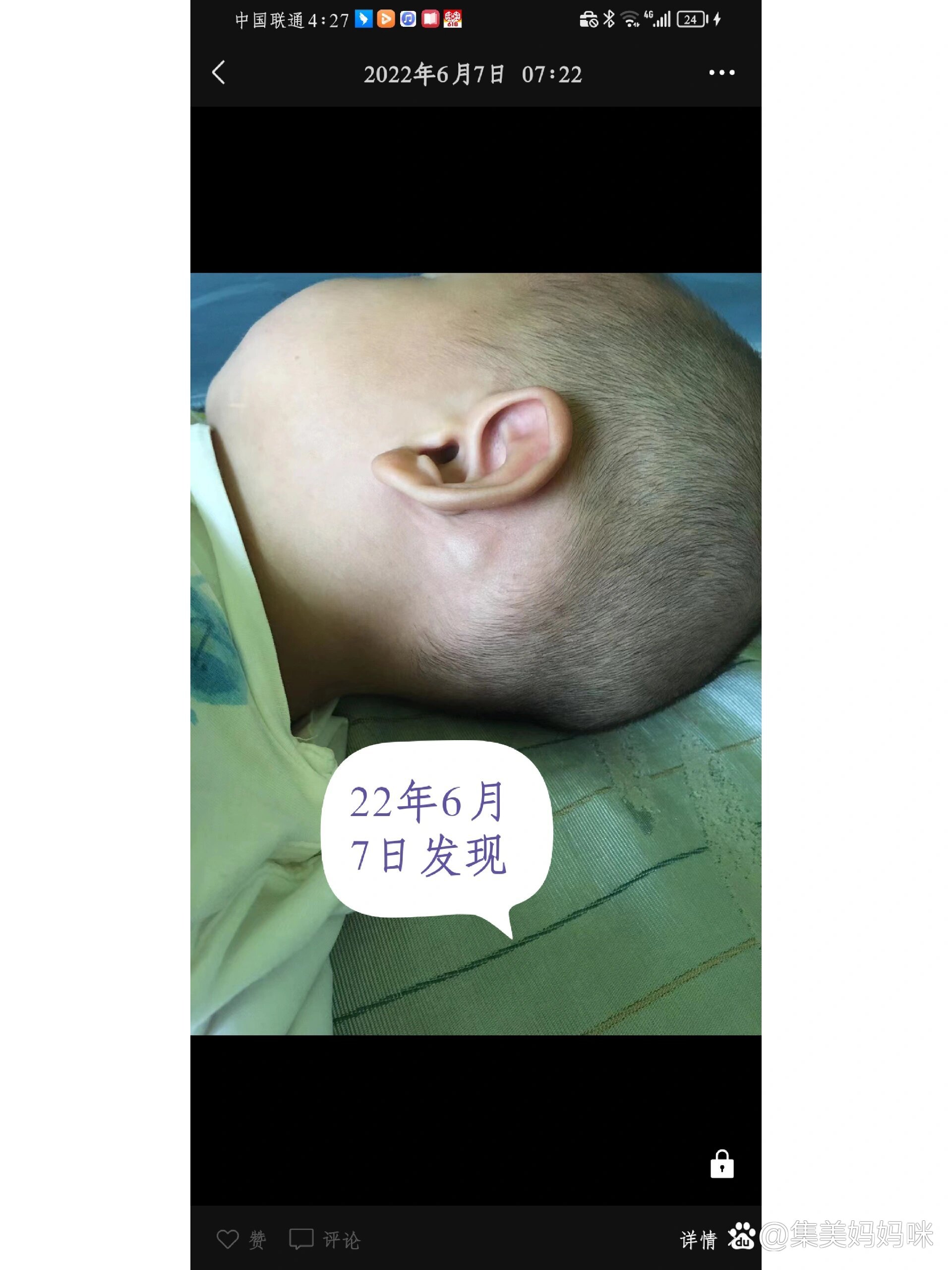 宝宝耳后淋巴结