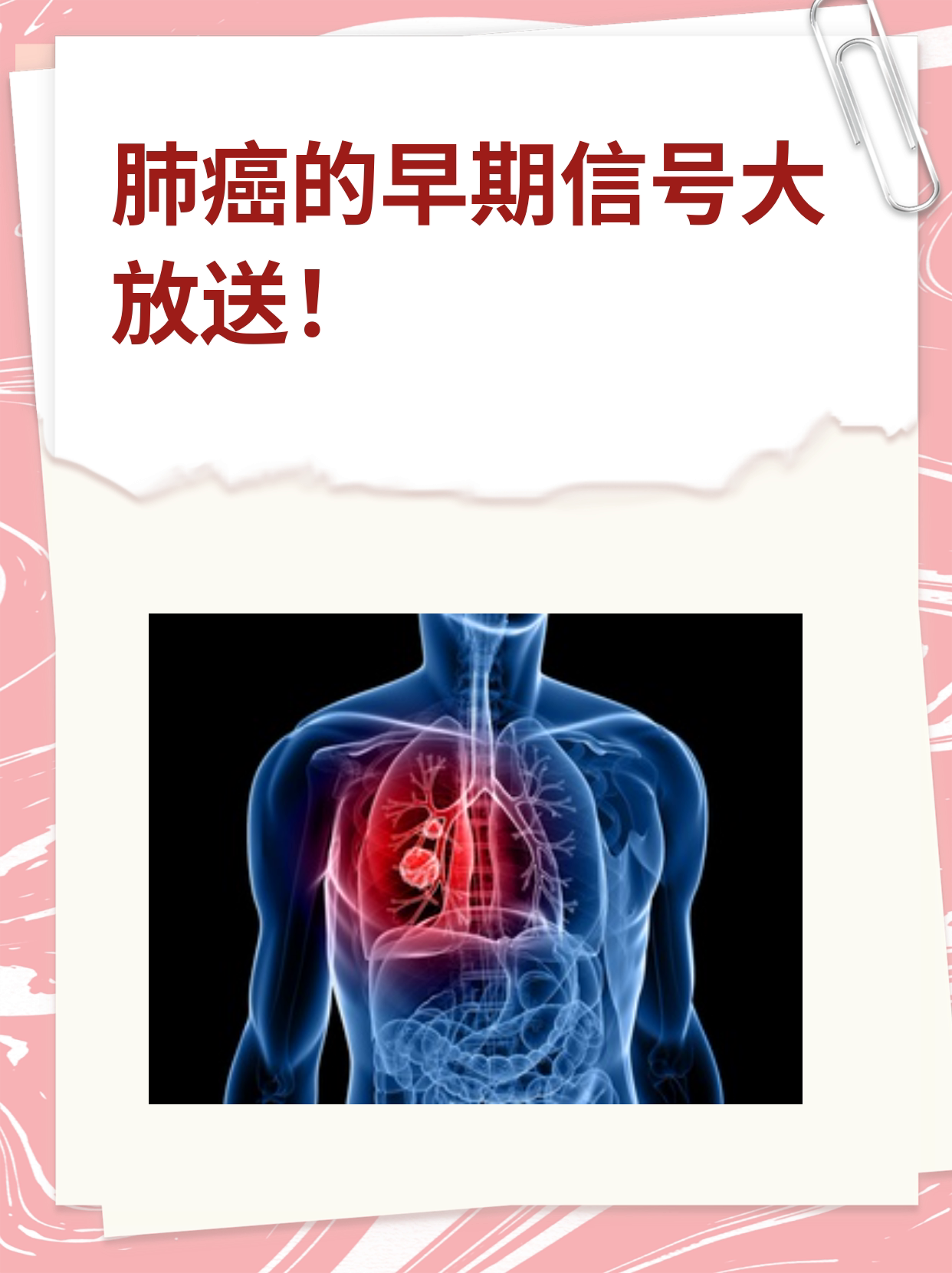 肺癌的早期信号大放送