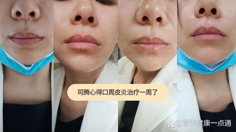 口周皮炎好多年…实时测评第6天