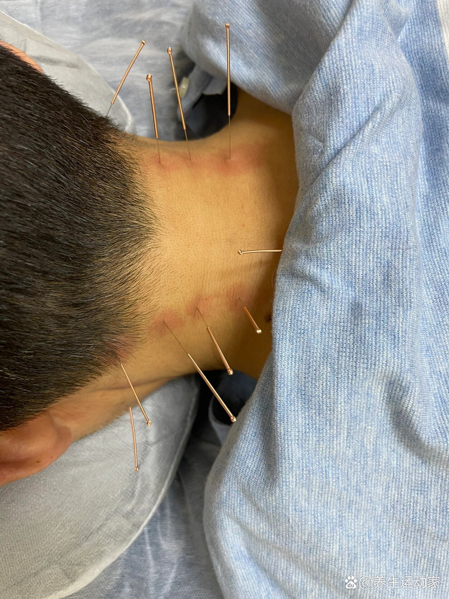 p>中医颈椎针灸有疗效 br>颈椎病针灸有效果,颈椎病分为脊髓型,椎