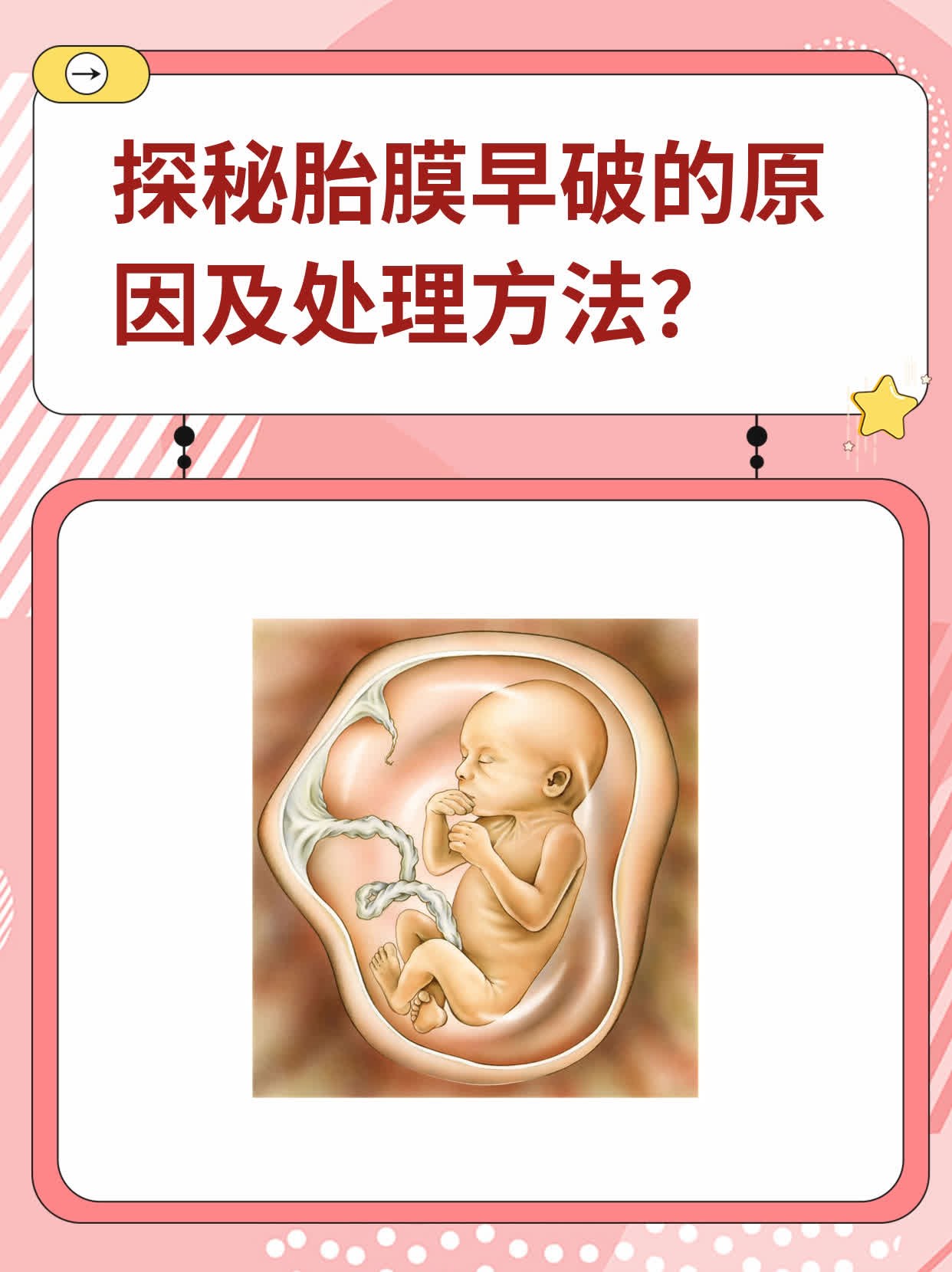 探秘胎膜早破的原因及处理方法
