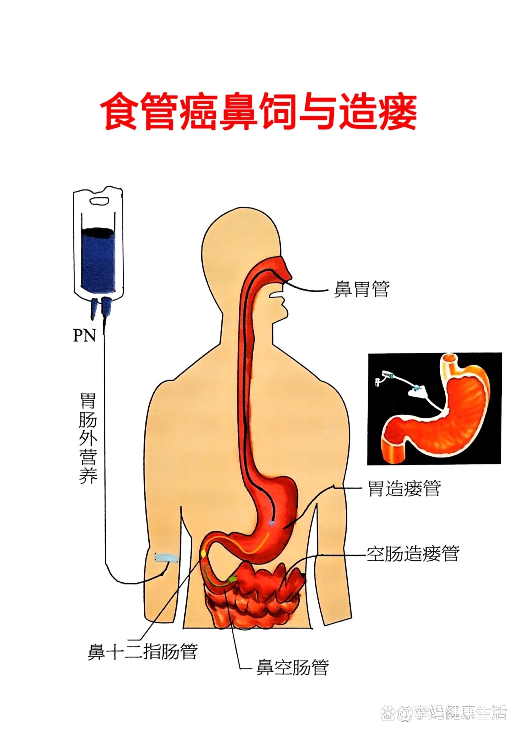 胃管在鼻腔的解剖图图片