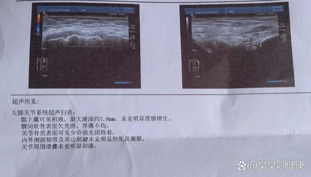 膝关节积液超声报告图片