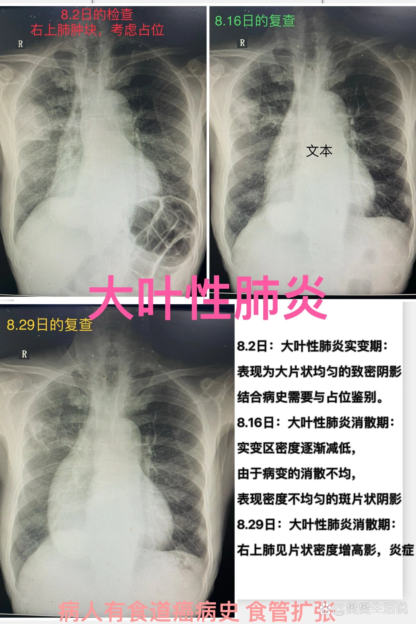 大叶性肺炎dr图片图片