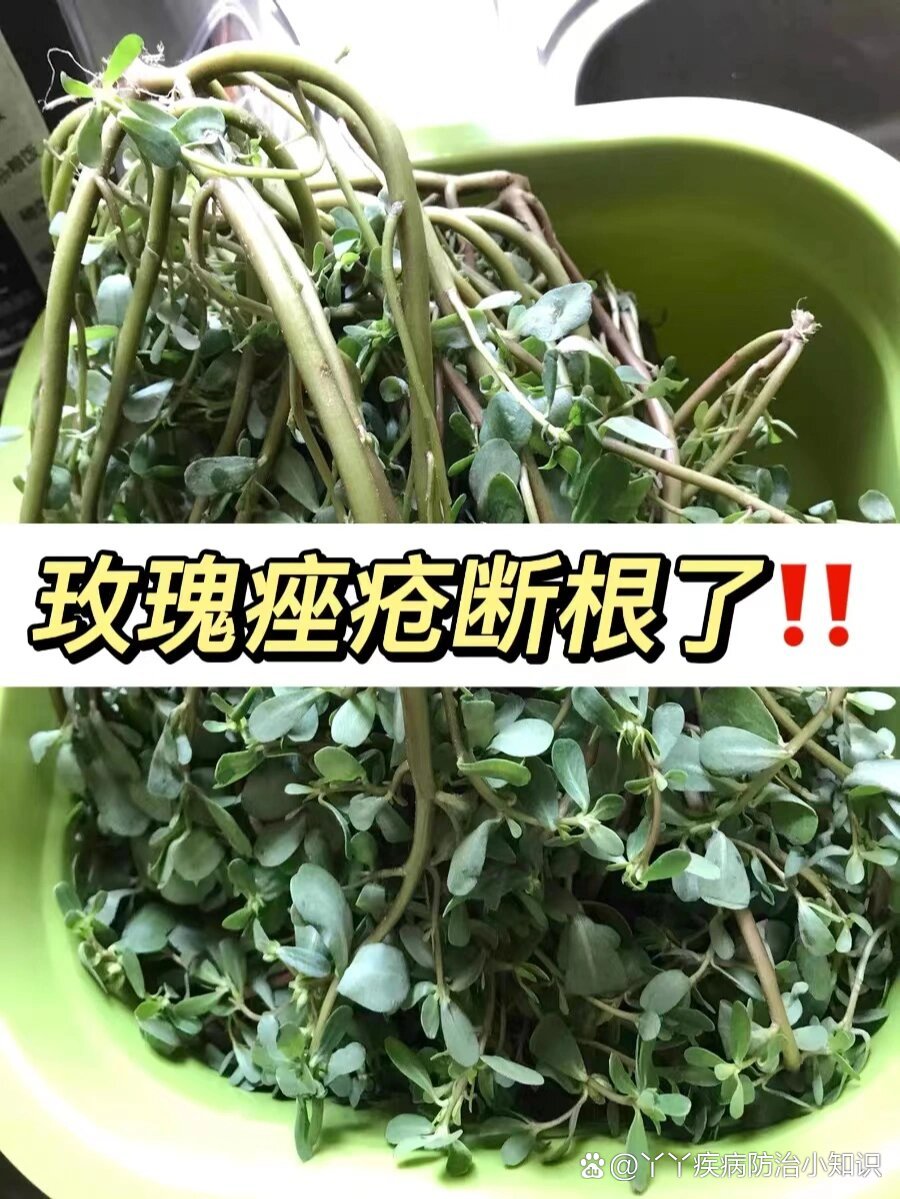 老中医给的治疗玫瑰痤疮的方法!