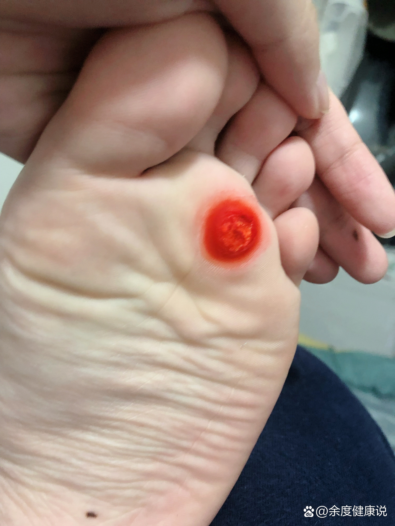 脚底长鸡眼痛苦不堪的治疗过程