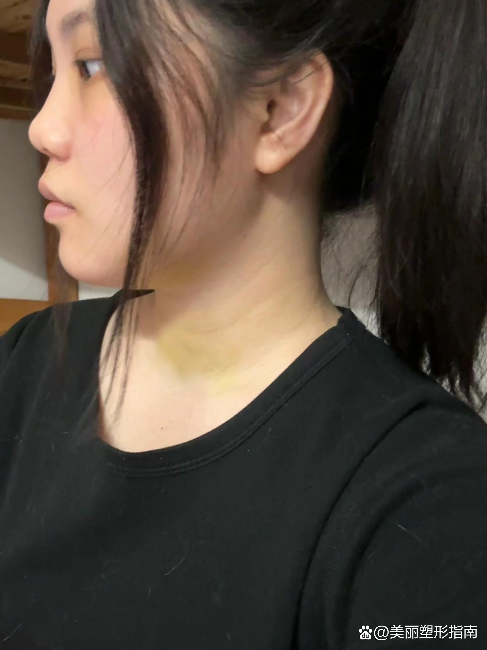 颏成型live图对比