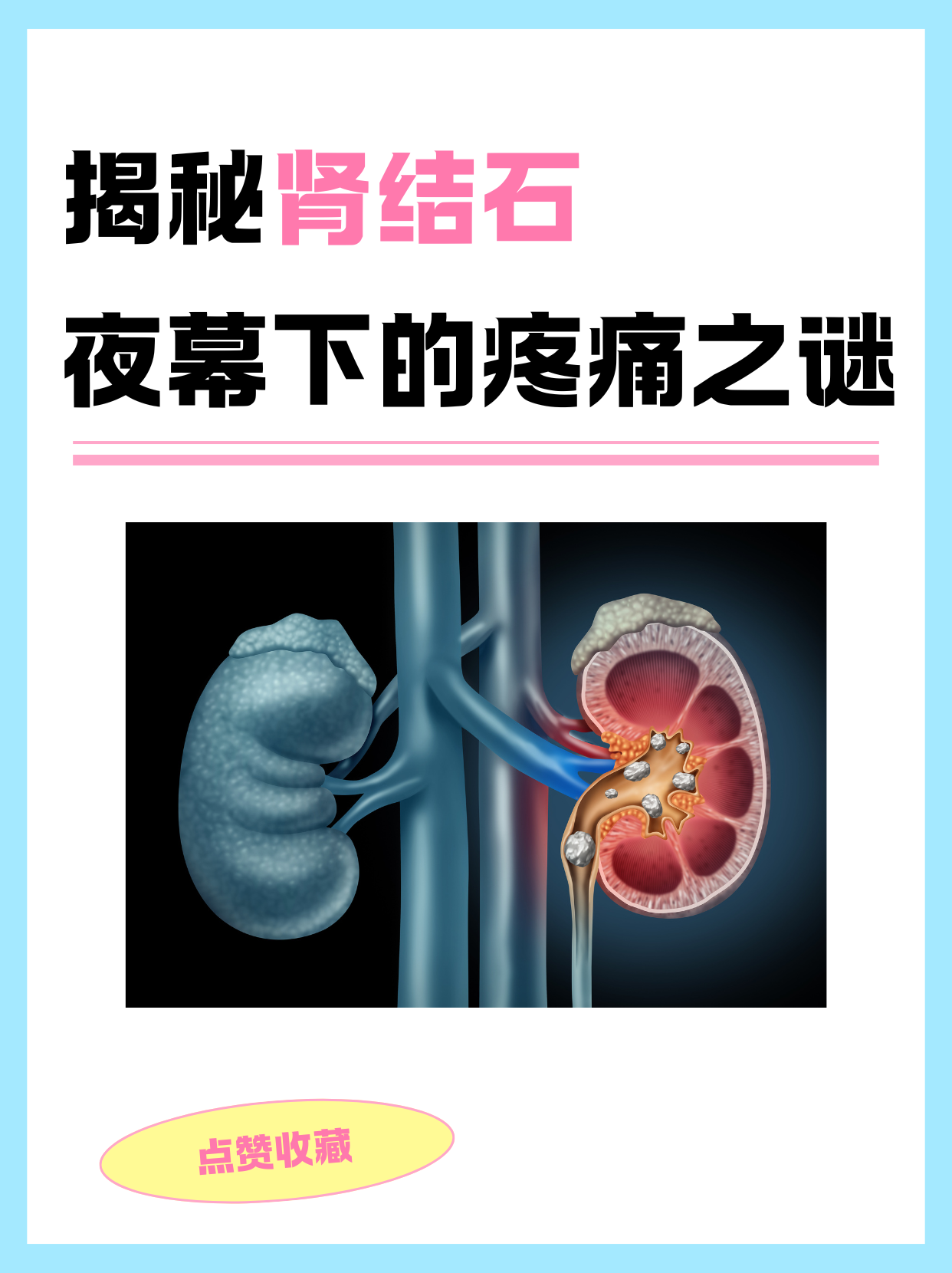 肾结石症状疼痛位置图图片