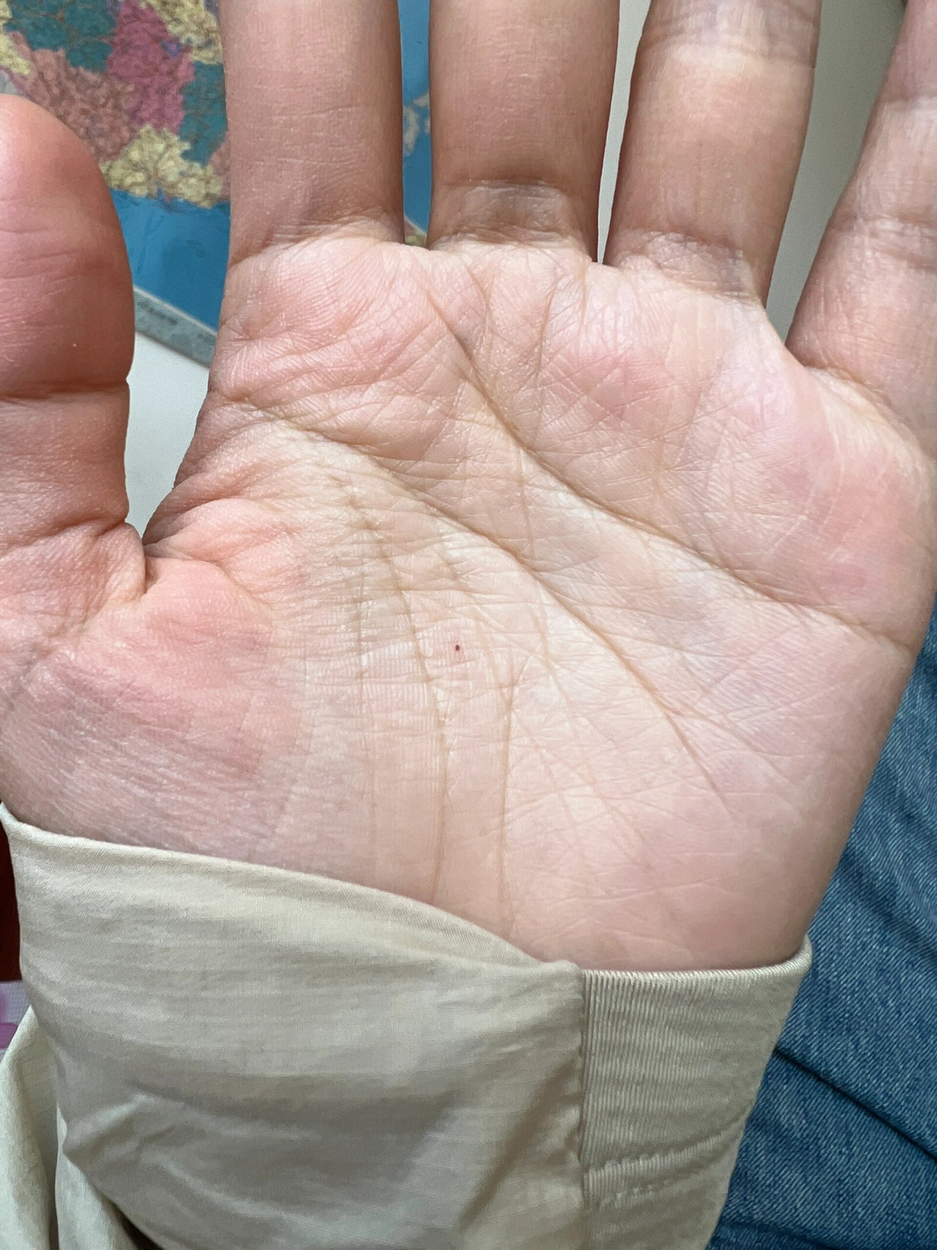 产后手心长了个红痣