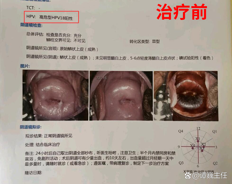 做了检查,然而不幸的是却诊断出宫颈病变,并筛查出高危型hpv18阳性