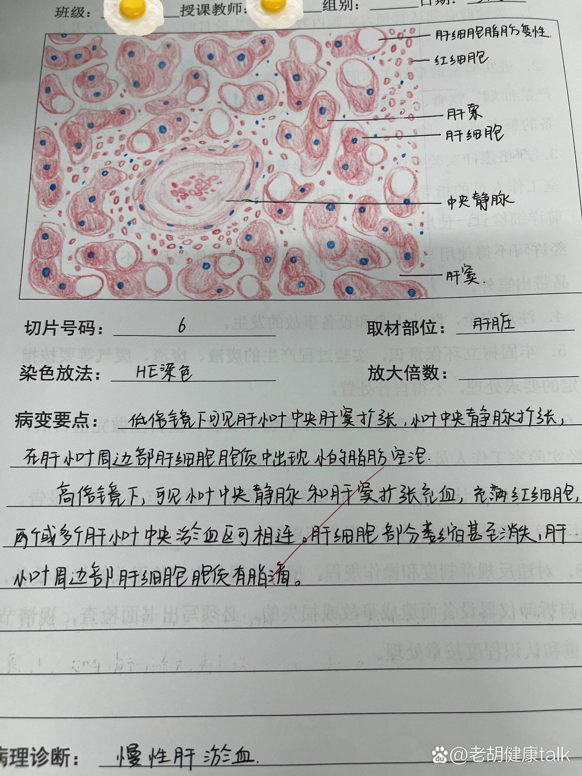 绘制肝硬化镜下红蓝图图片