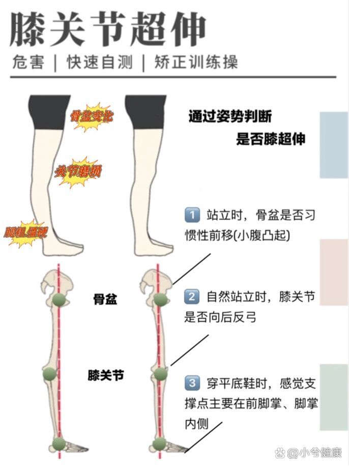 腿形变直只需五个动作6015膝超伸 腿粗/肚