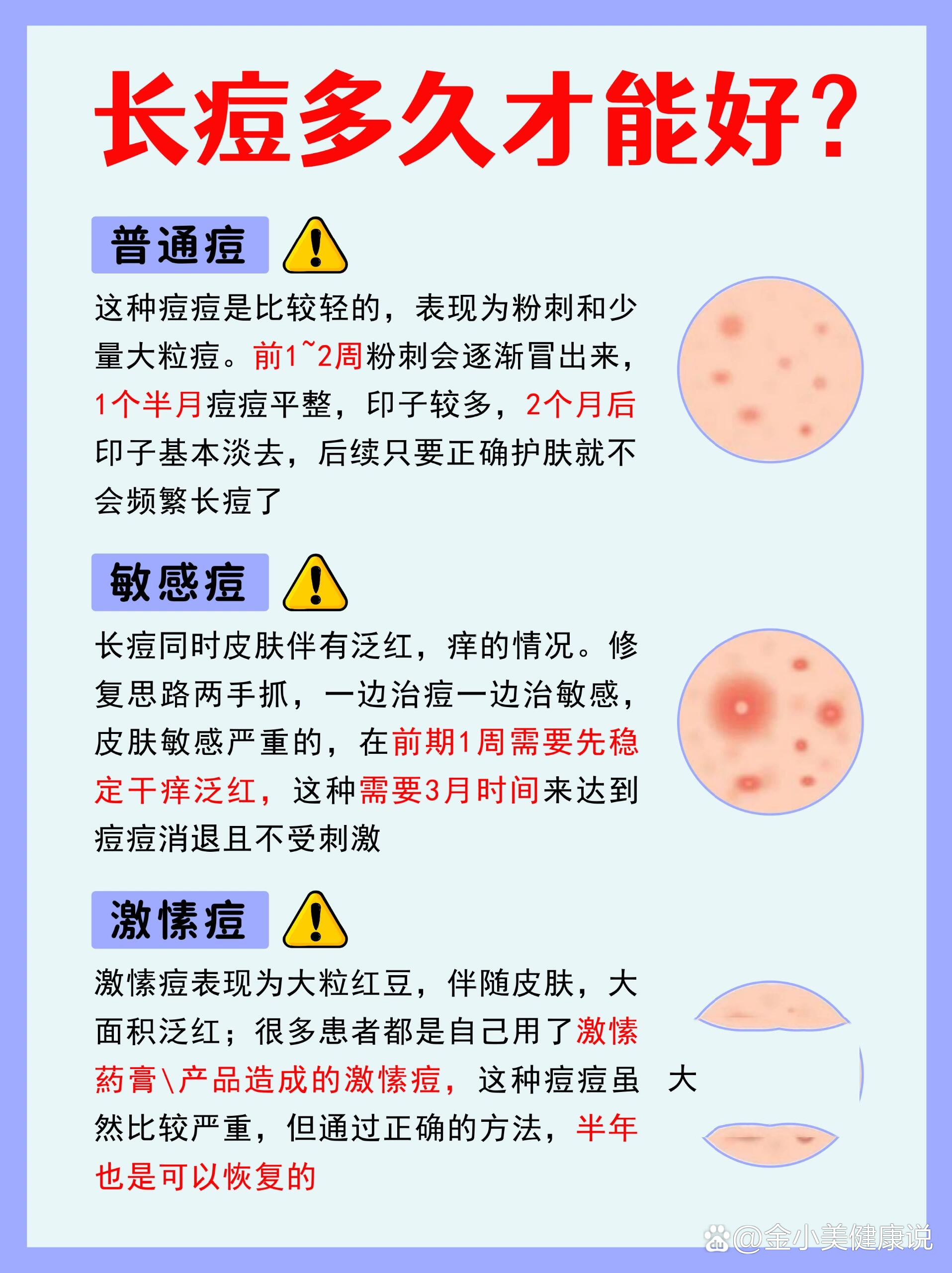 长痘多久才能好71解析不同类型痘痘的恢复73