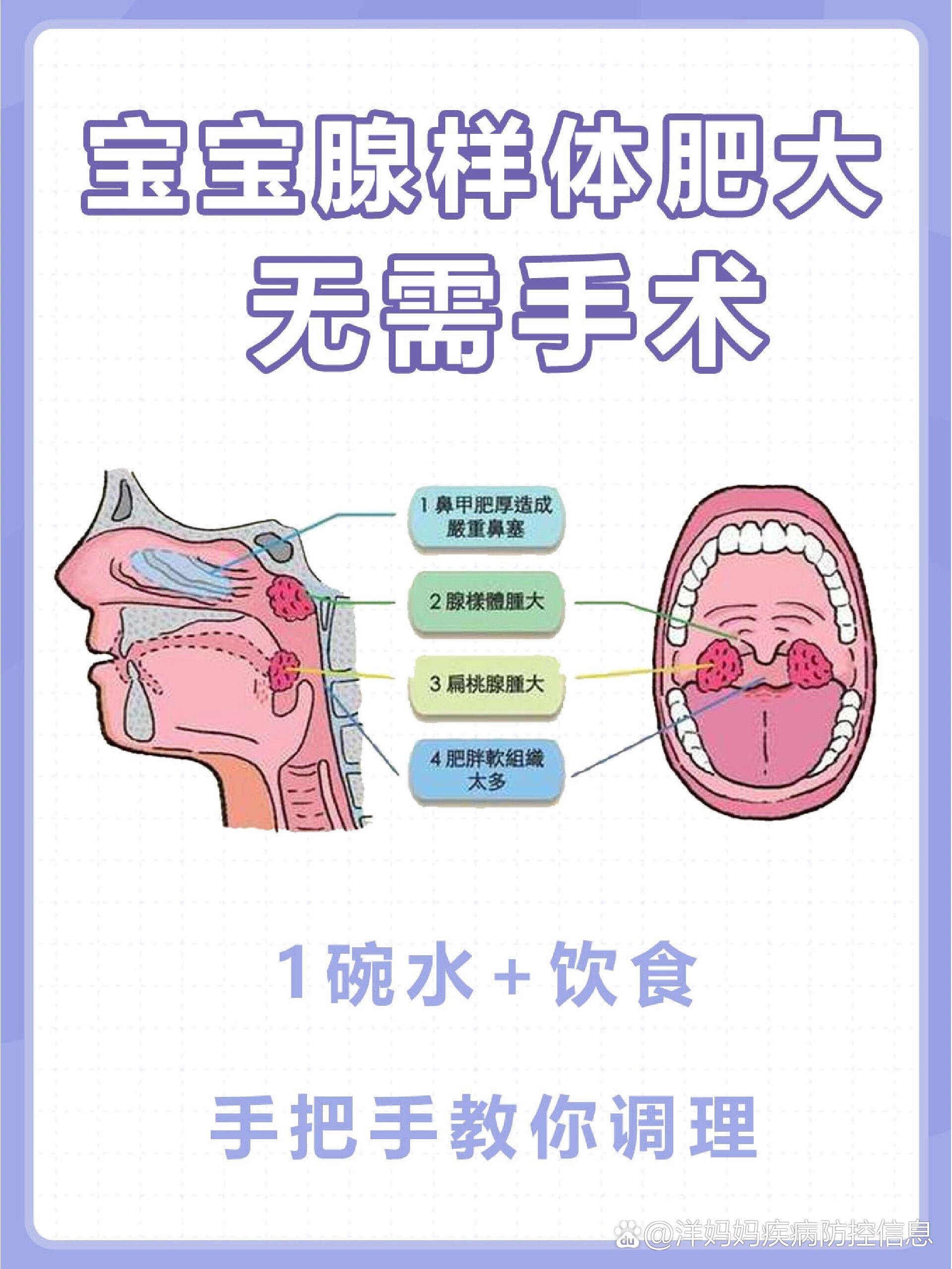 宝宝腺样体肥大无需手术‼️1碗水教你调理