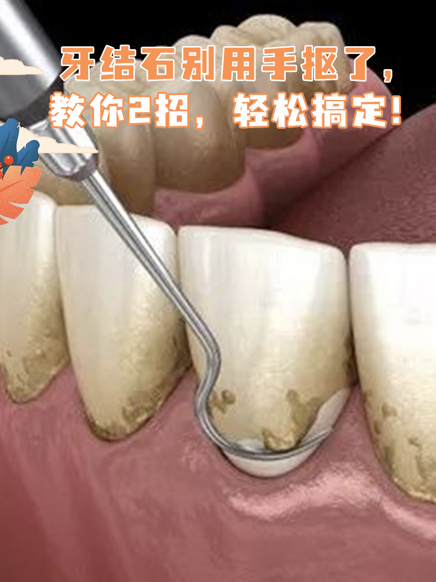 作为一个被牙结石困扰多年,尝试了几十种去除牙结石方法的人,终于让我