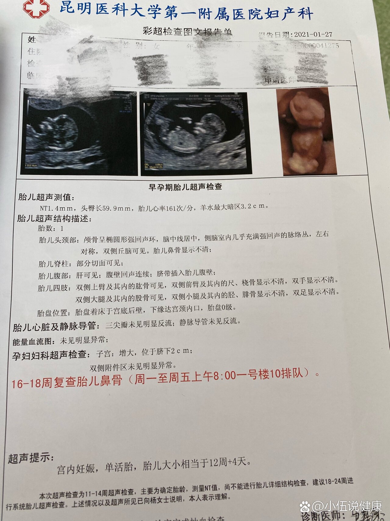 nt鼻骨不清12周