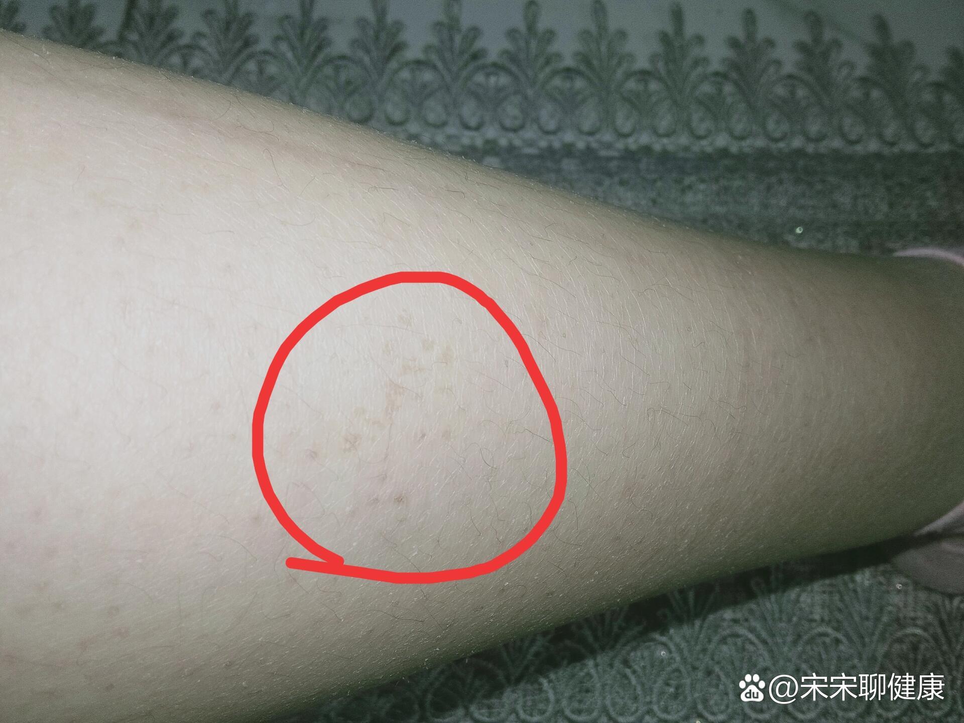 7年前被咬没打针还有救吗