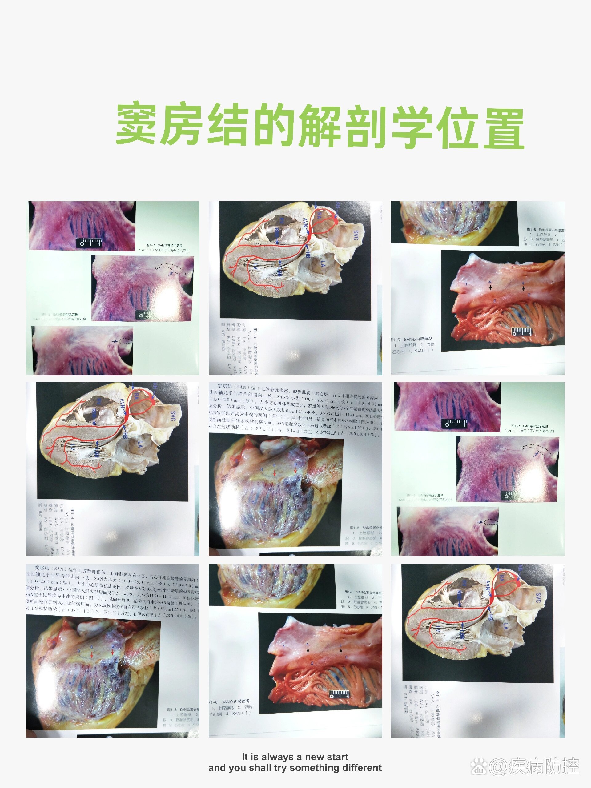 窦房结怎么找