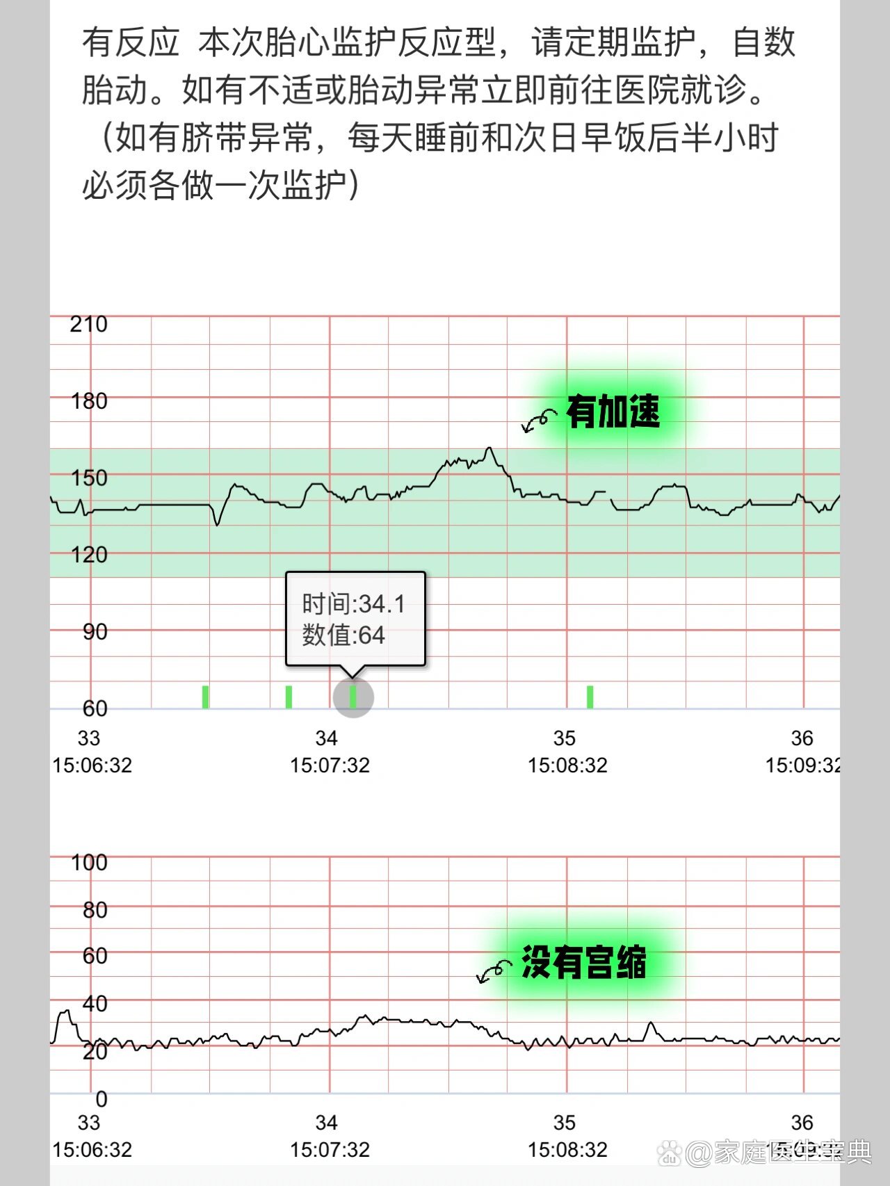 正常的胎心监护曲线图图片