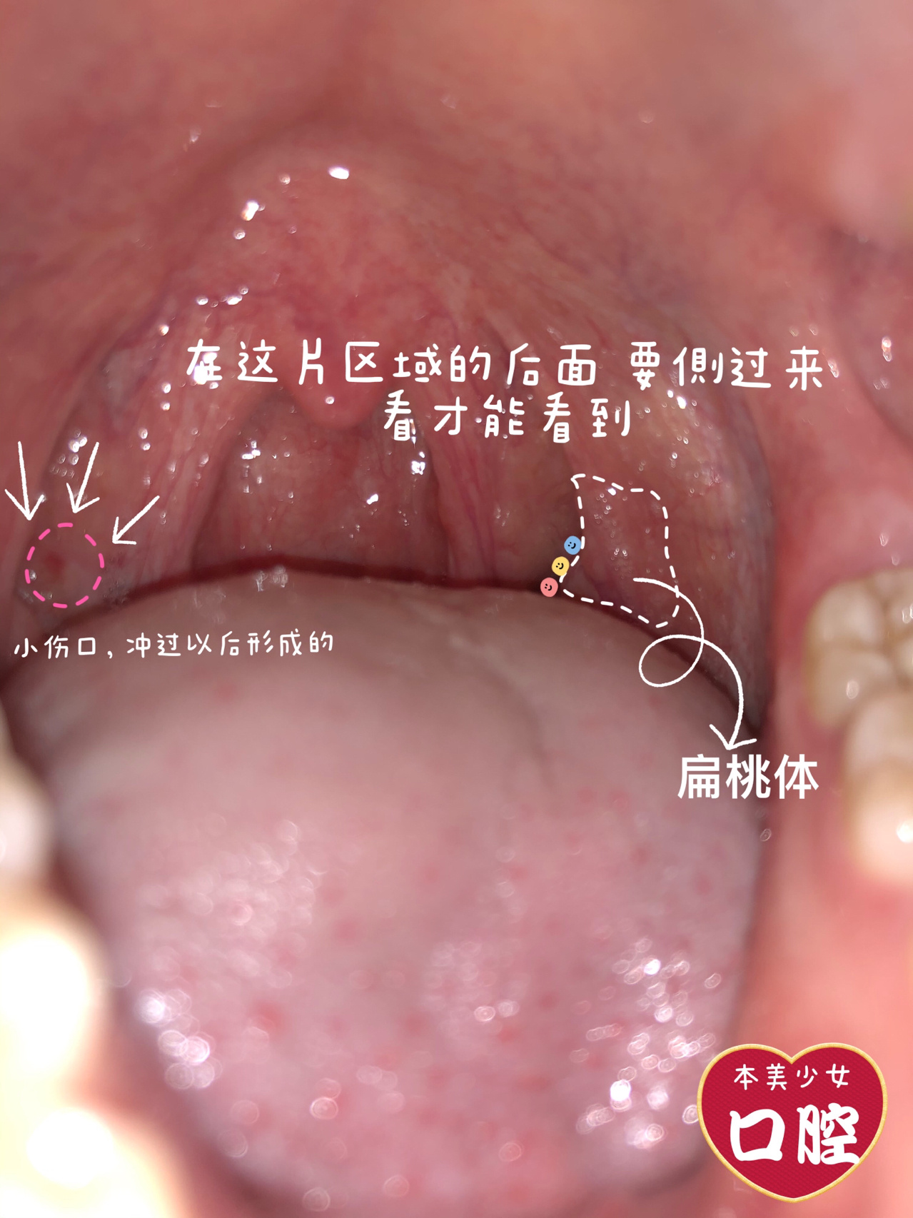 扁桃体结石的位置91