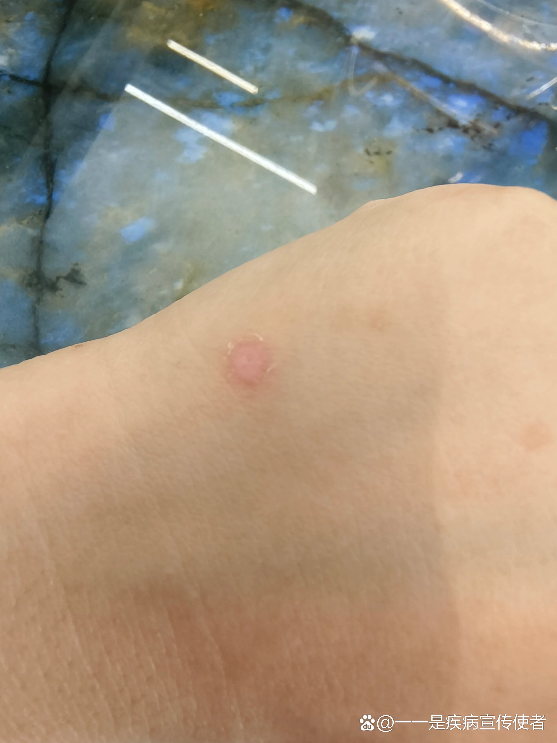 水痘留的疤,会自动修复吗