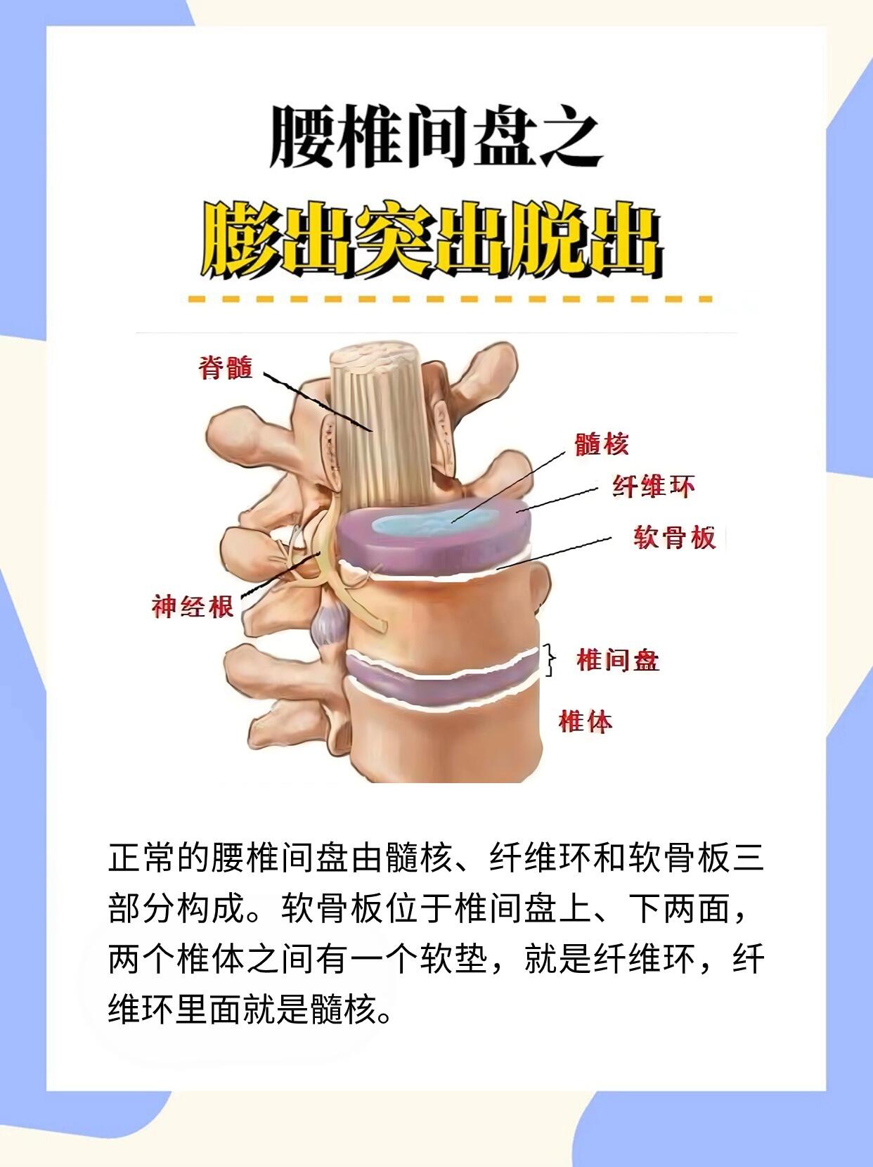 腰椎间盘之膨出突出脱出