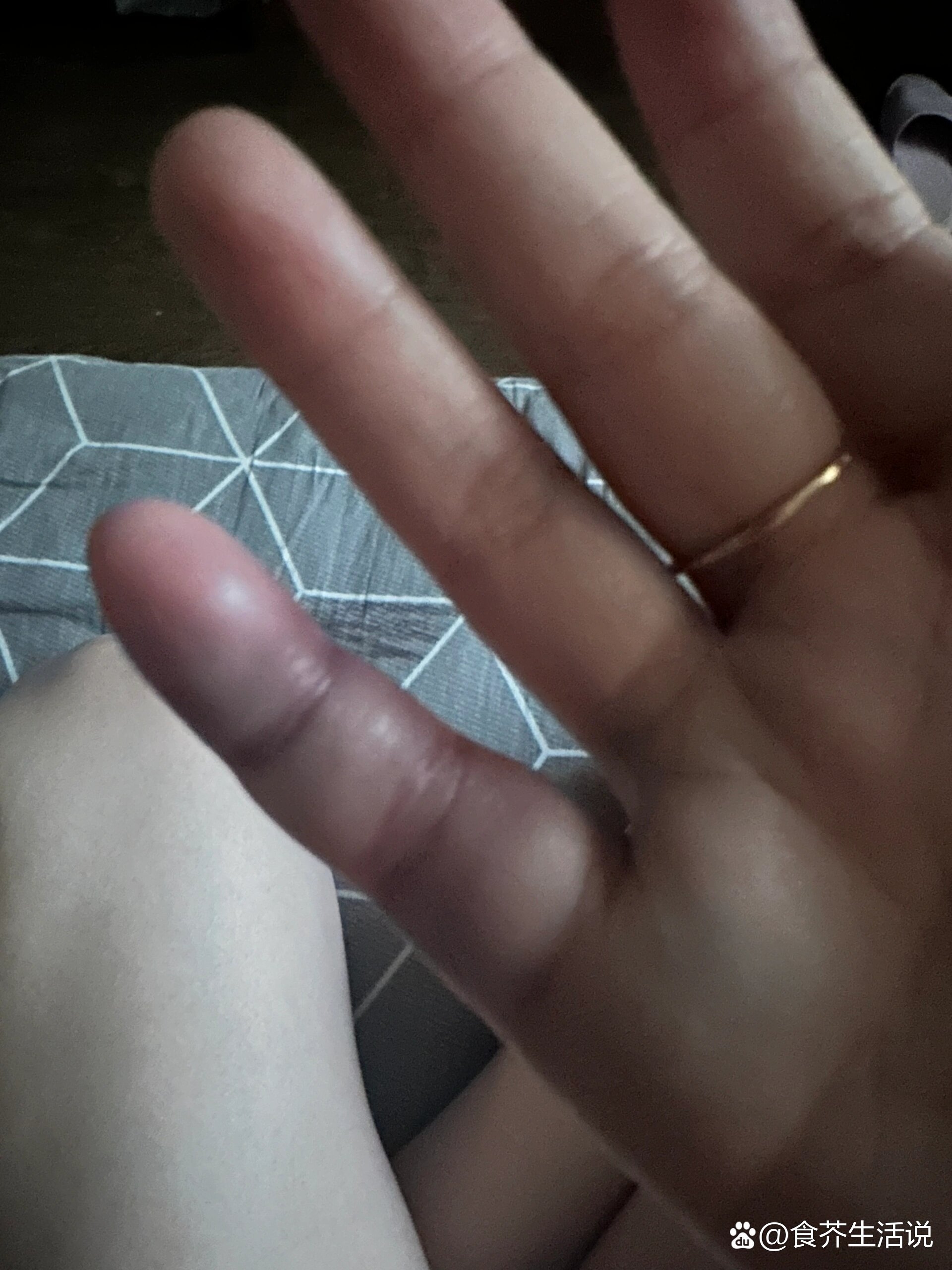 手指骨折全记录