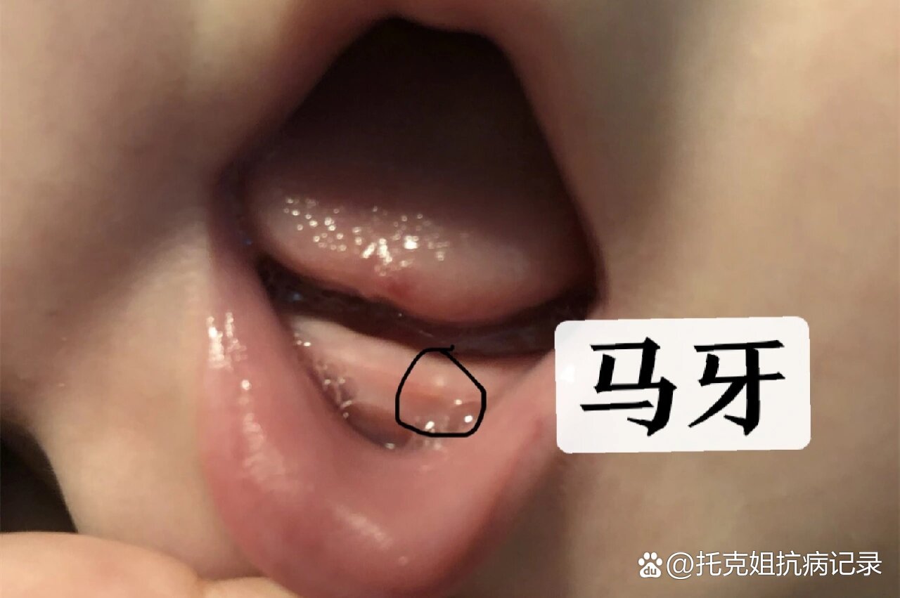 婴儿👶牙龈上的小白点是怎么回事‼️