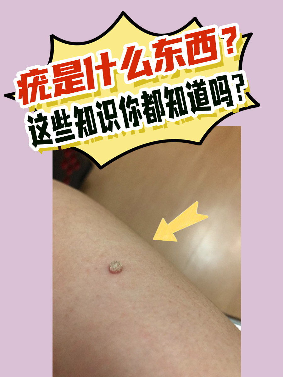 疣是什么东西?这些知识你都知道吗?