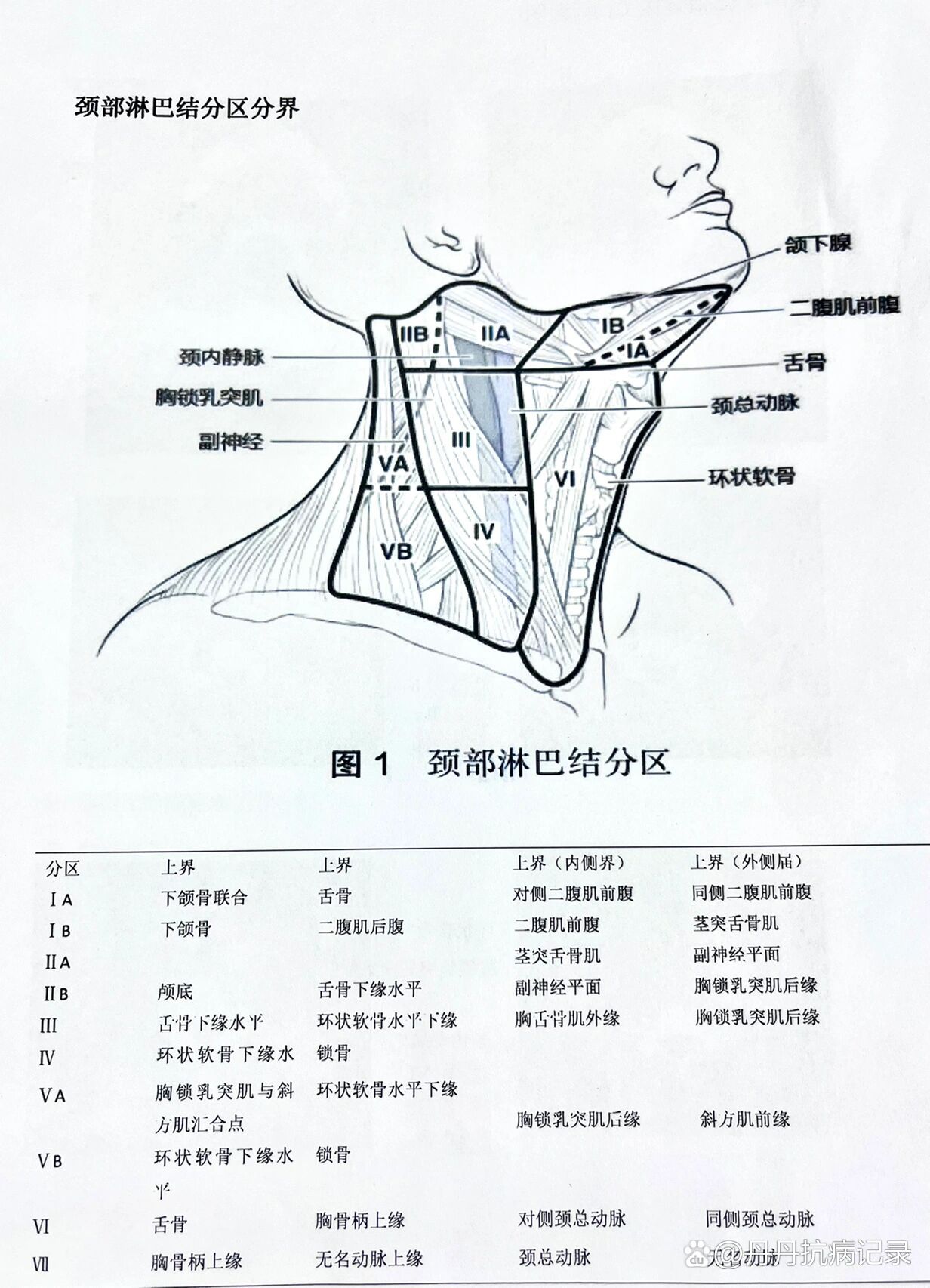 颈部淋巴结分区ct示意图//鼻咽癌