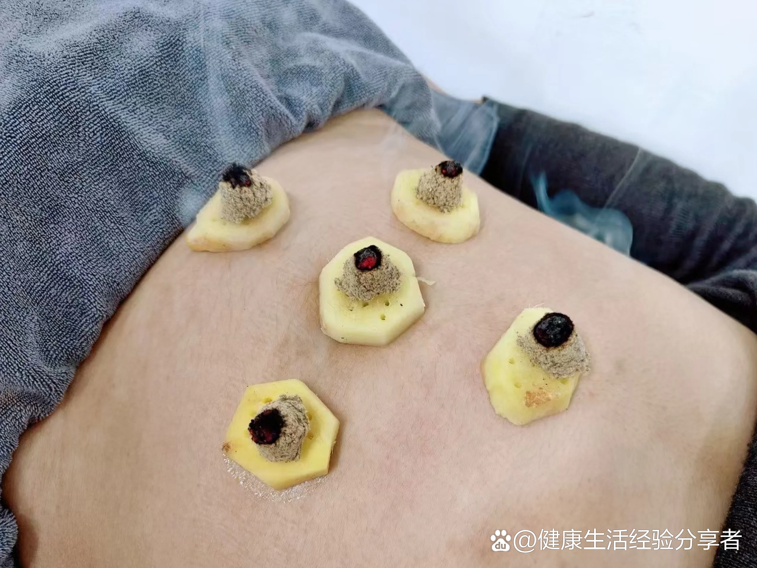 中医艾灸,隔姜灸效果太好了!
