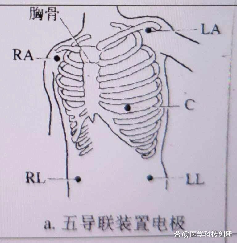 是谁心电监护电极片位置还迷迷瞪瞪?