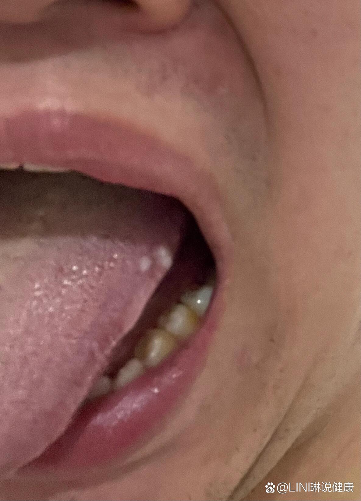 有人知道舌头白色这个是什么吗