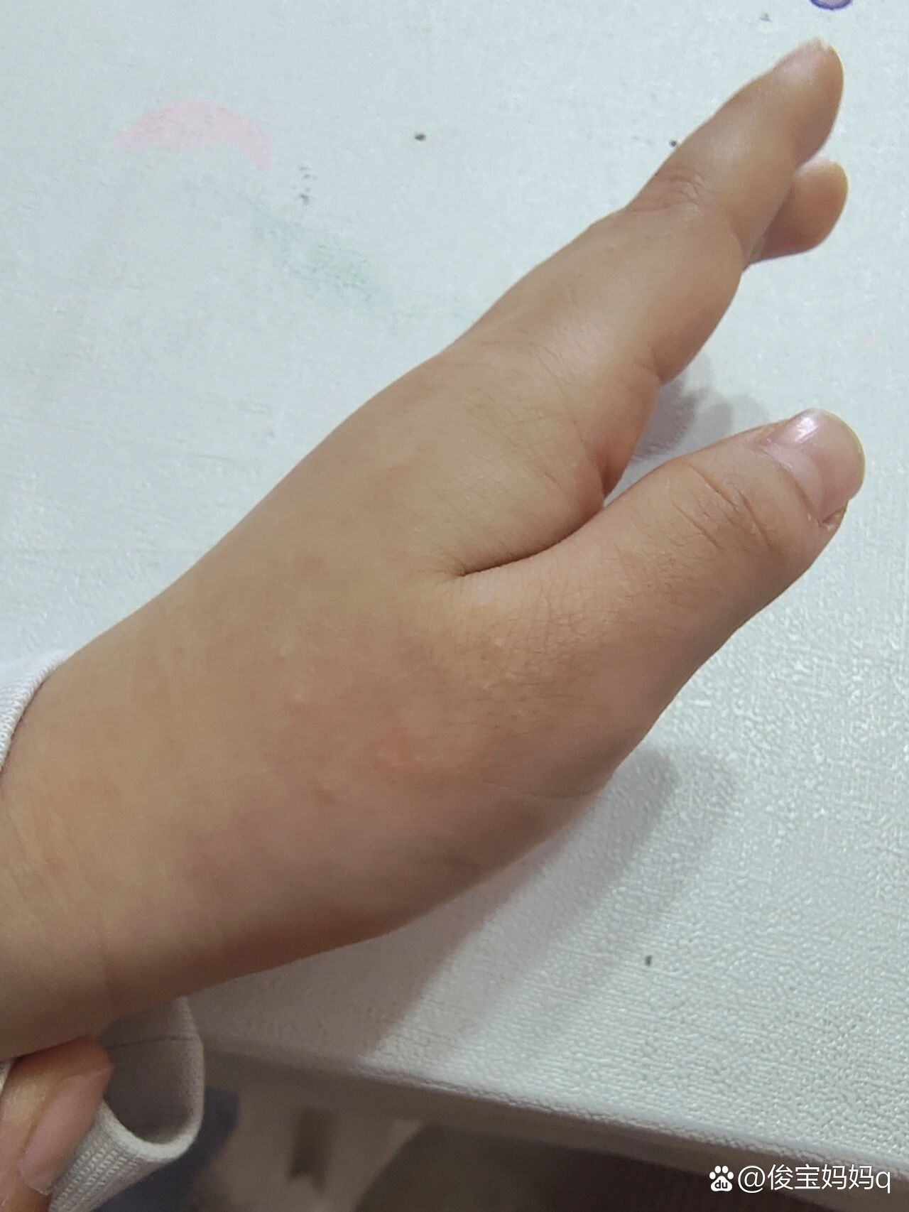 求助,宝宝手上起小疙瘩是什么?