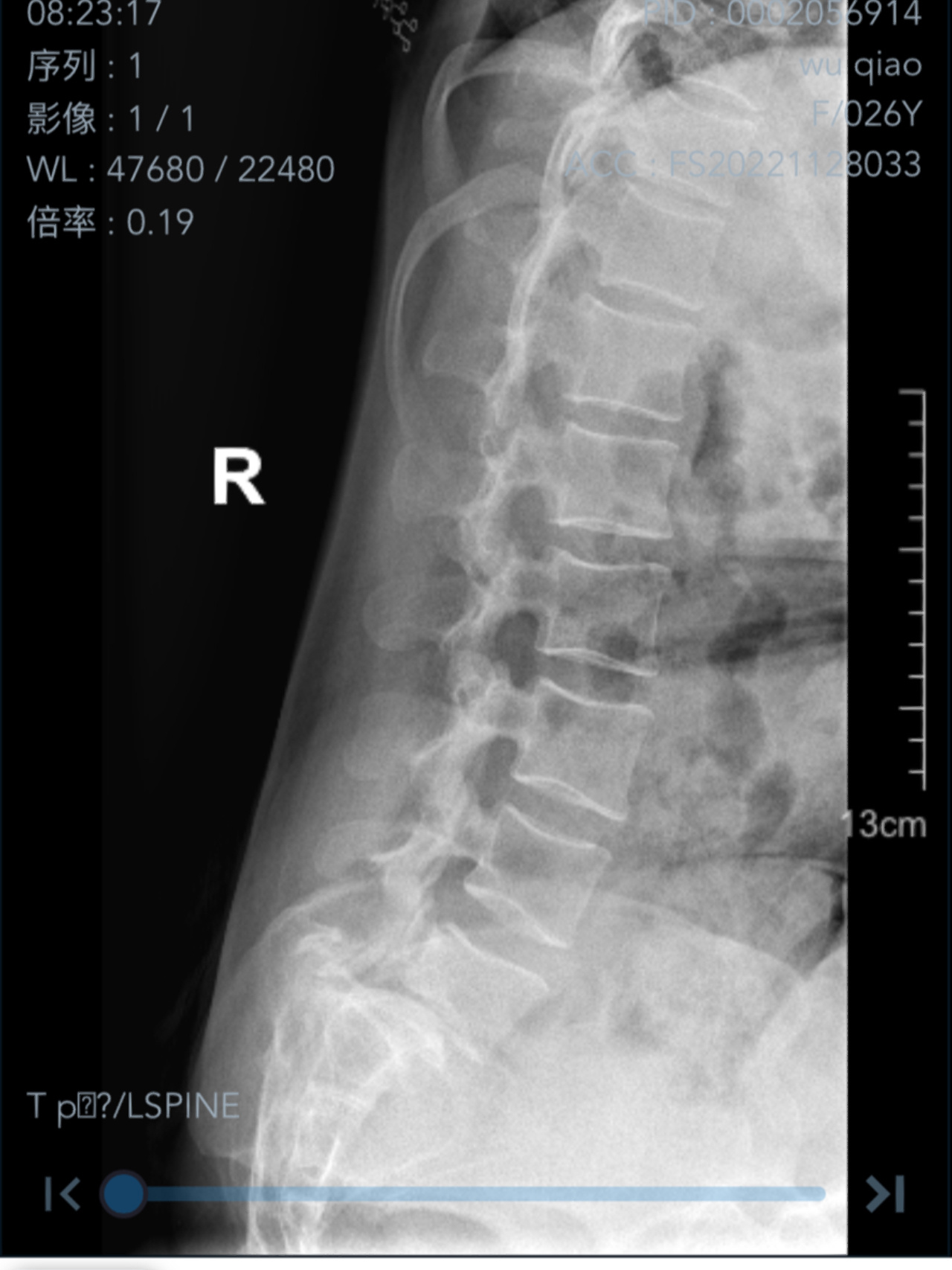 腰椎滑脱片子图片