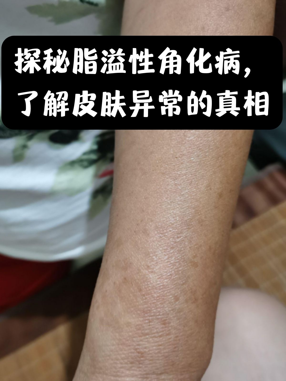 眼睑脂溢性角化病图片