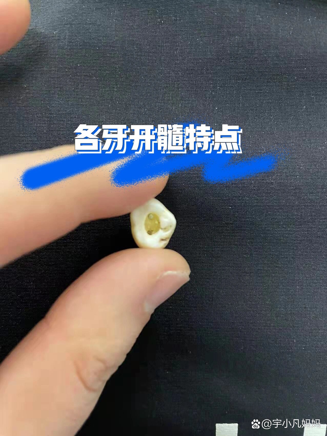 下颌六的开髓形态图片图片