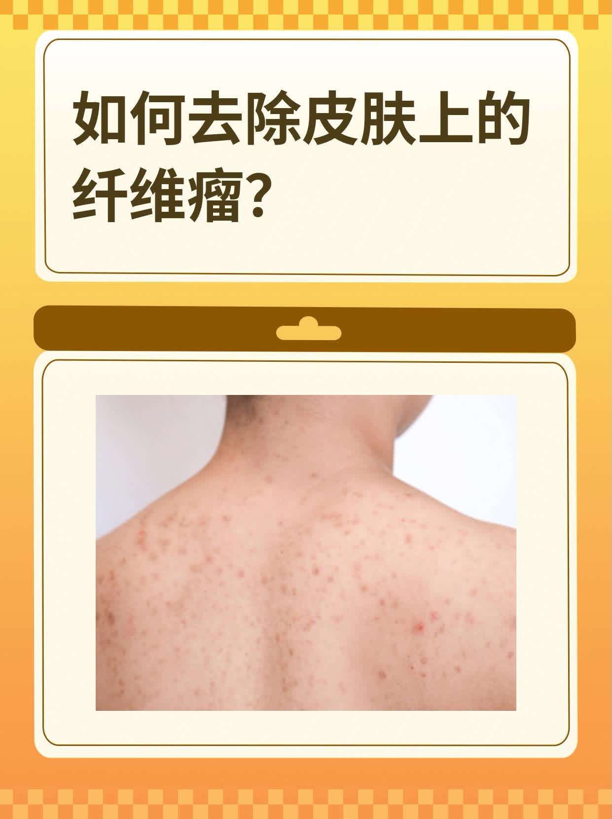 如何去除皮肤上的纤维瘤