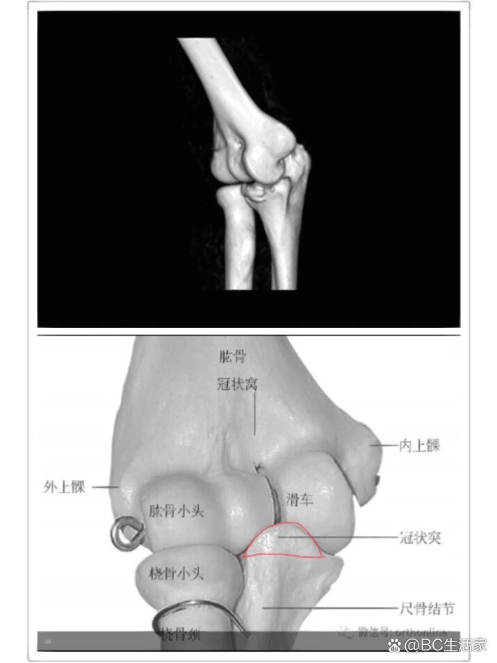 尺骨冠突解剖图片图片