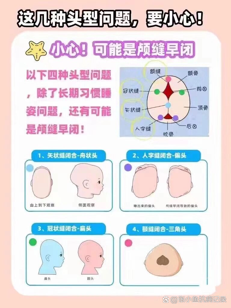 颅缝早闭手术成功率图片