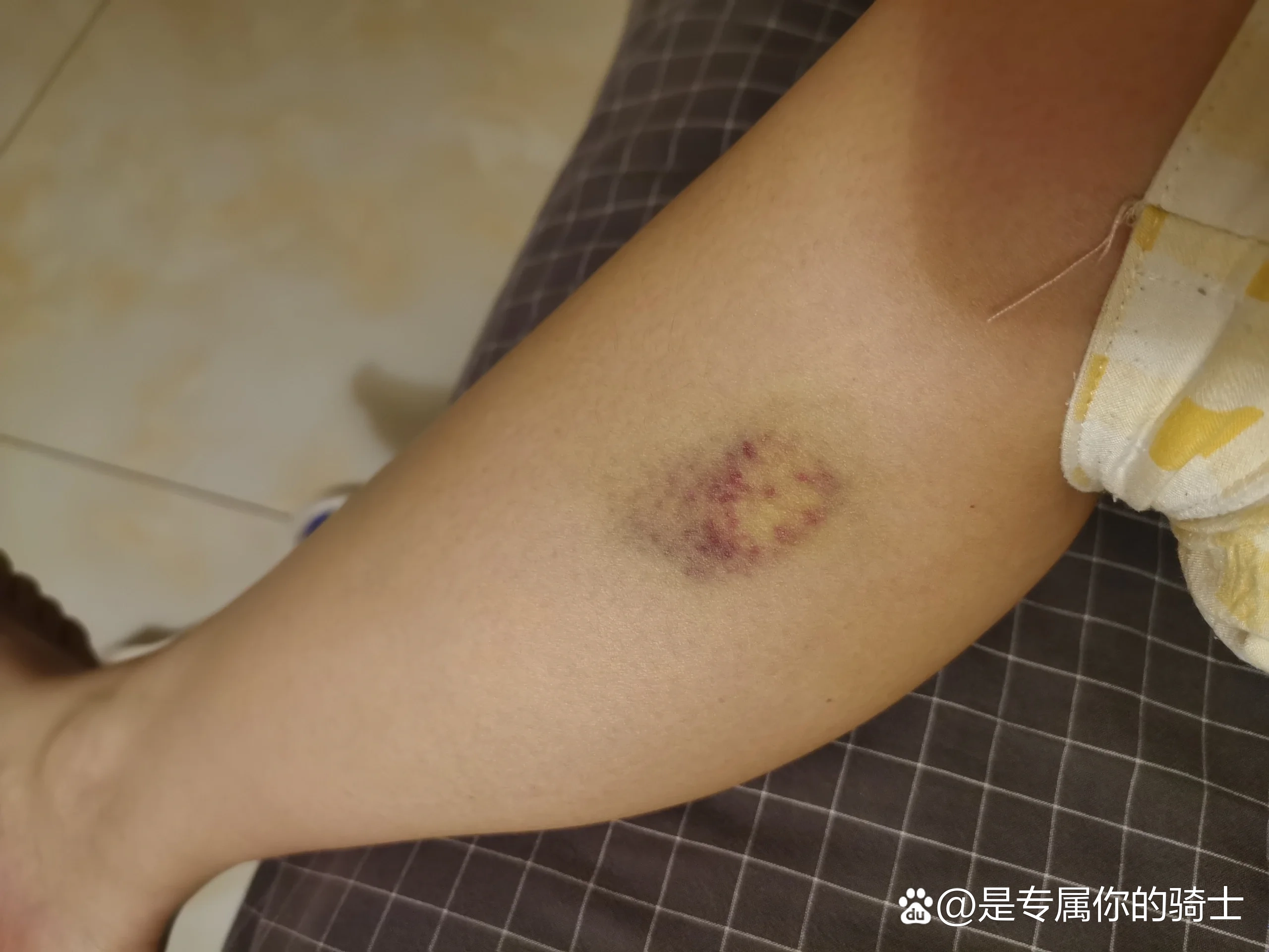 撞车撞出内伤了?
