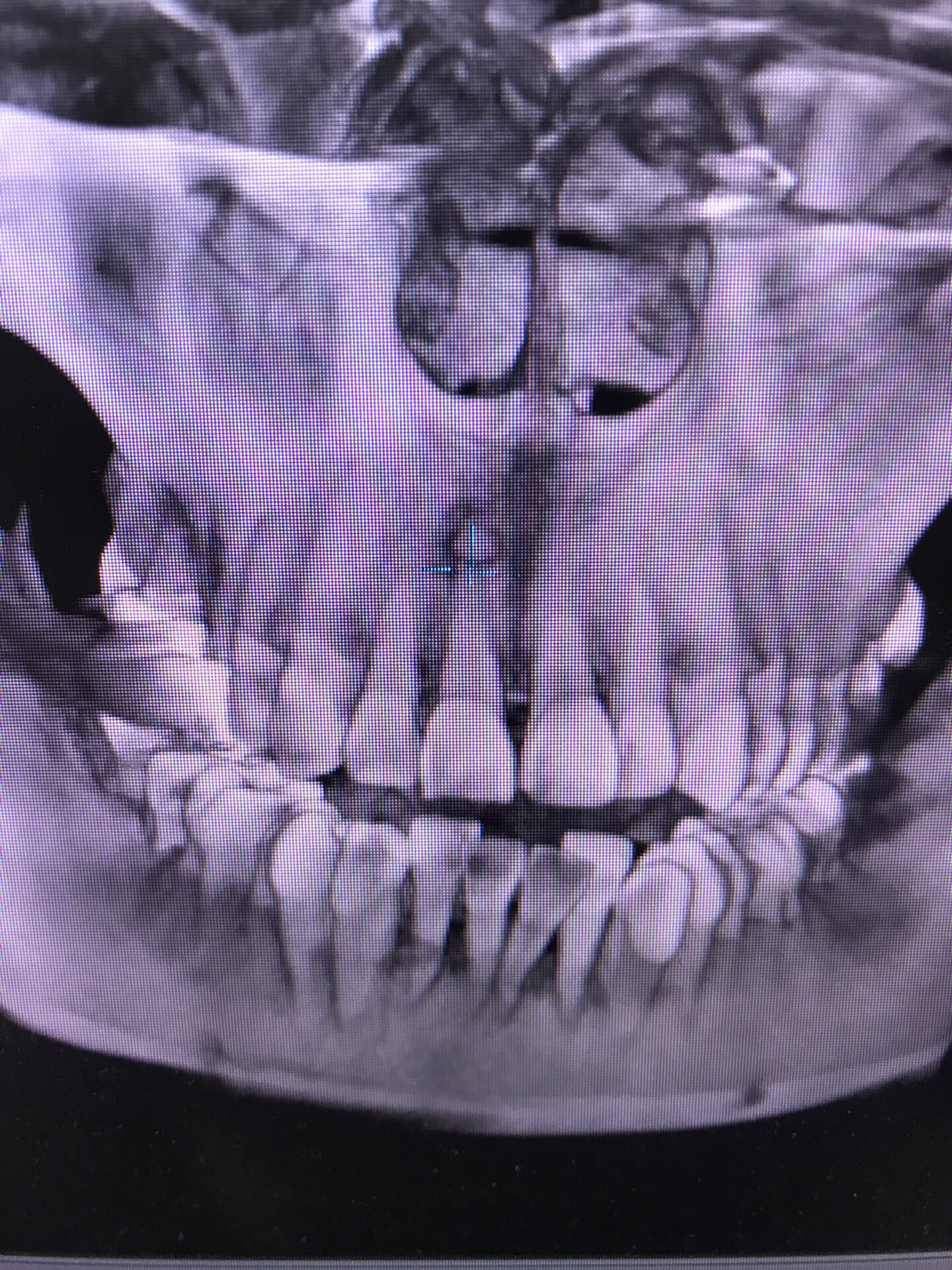 偶然发现牙骨质瘤1例,患者无症状,可暂不处理,若增大,可手术摘除