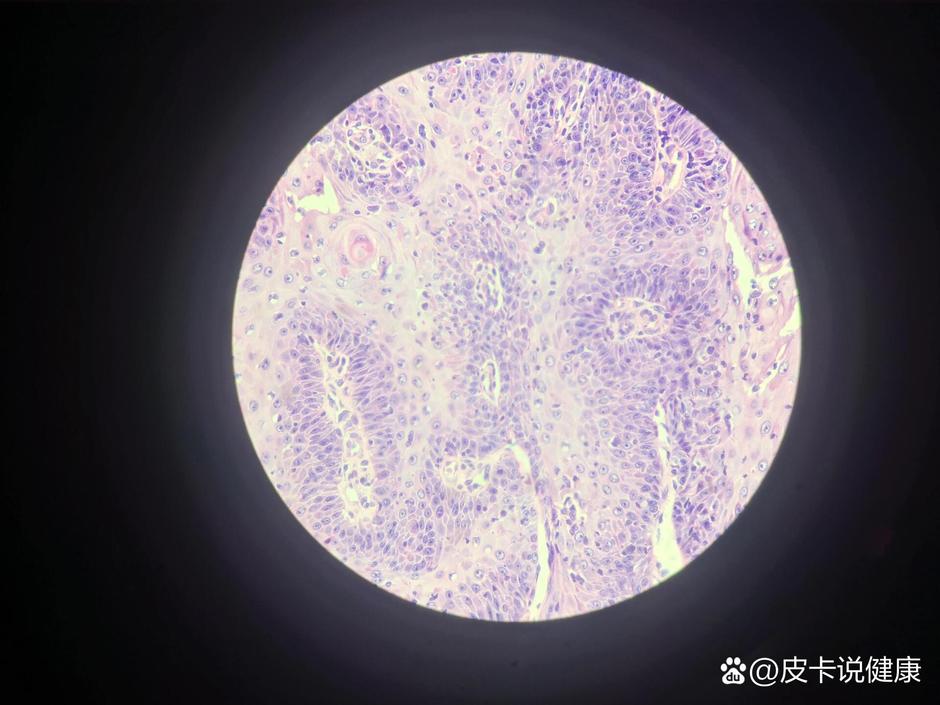 皮肤乳头状瘤
