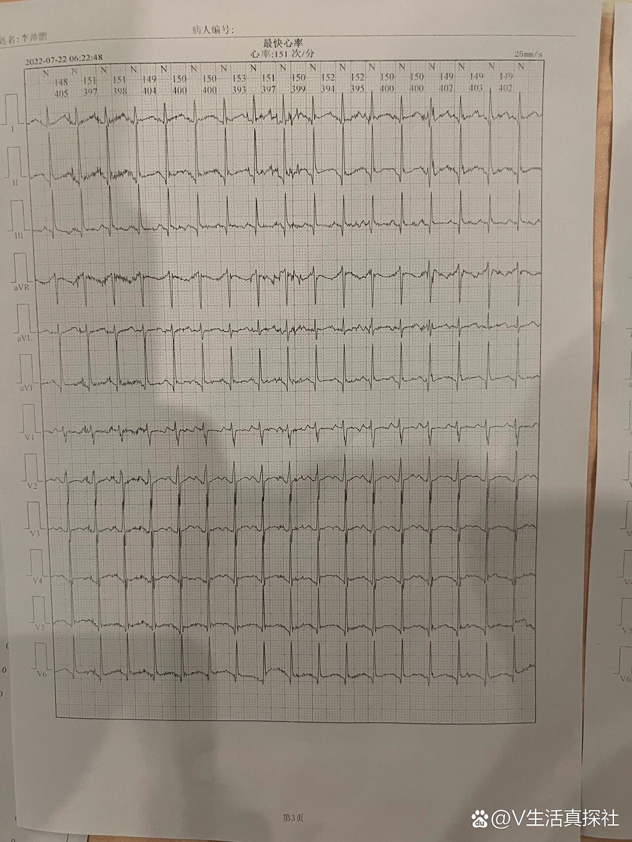 室上速心电图特征诊断图片