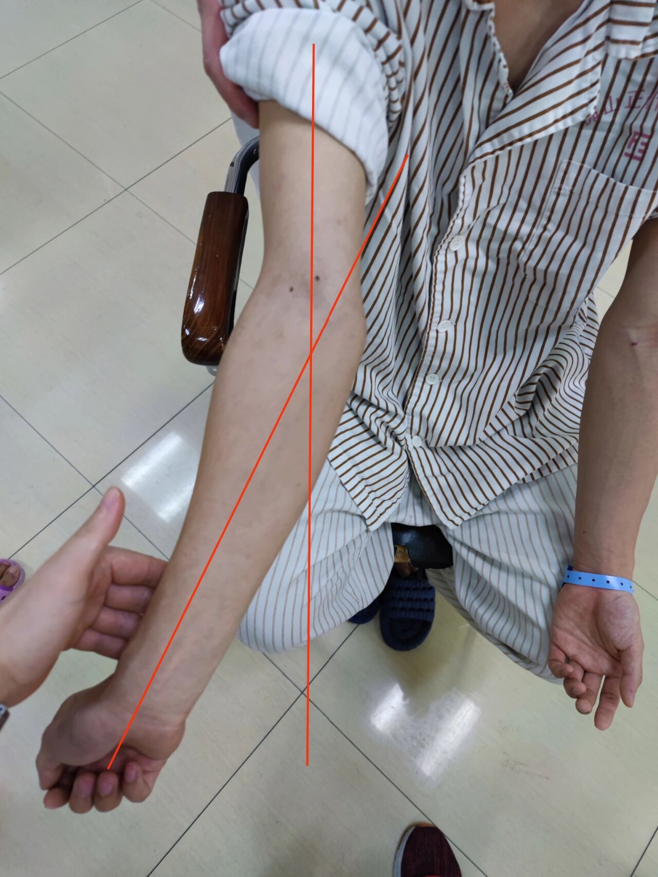 小时候骨折没弄好,肘关节外翻畸形
