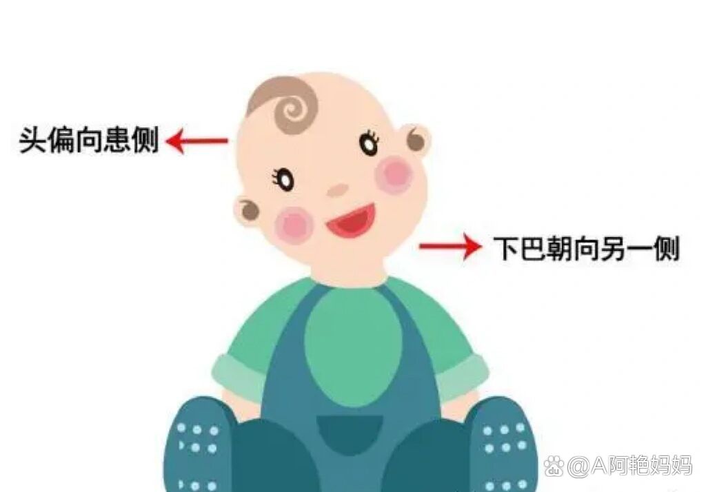 先天性斜颈图片婴儿图片