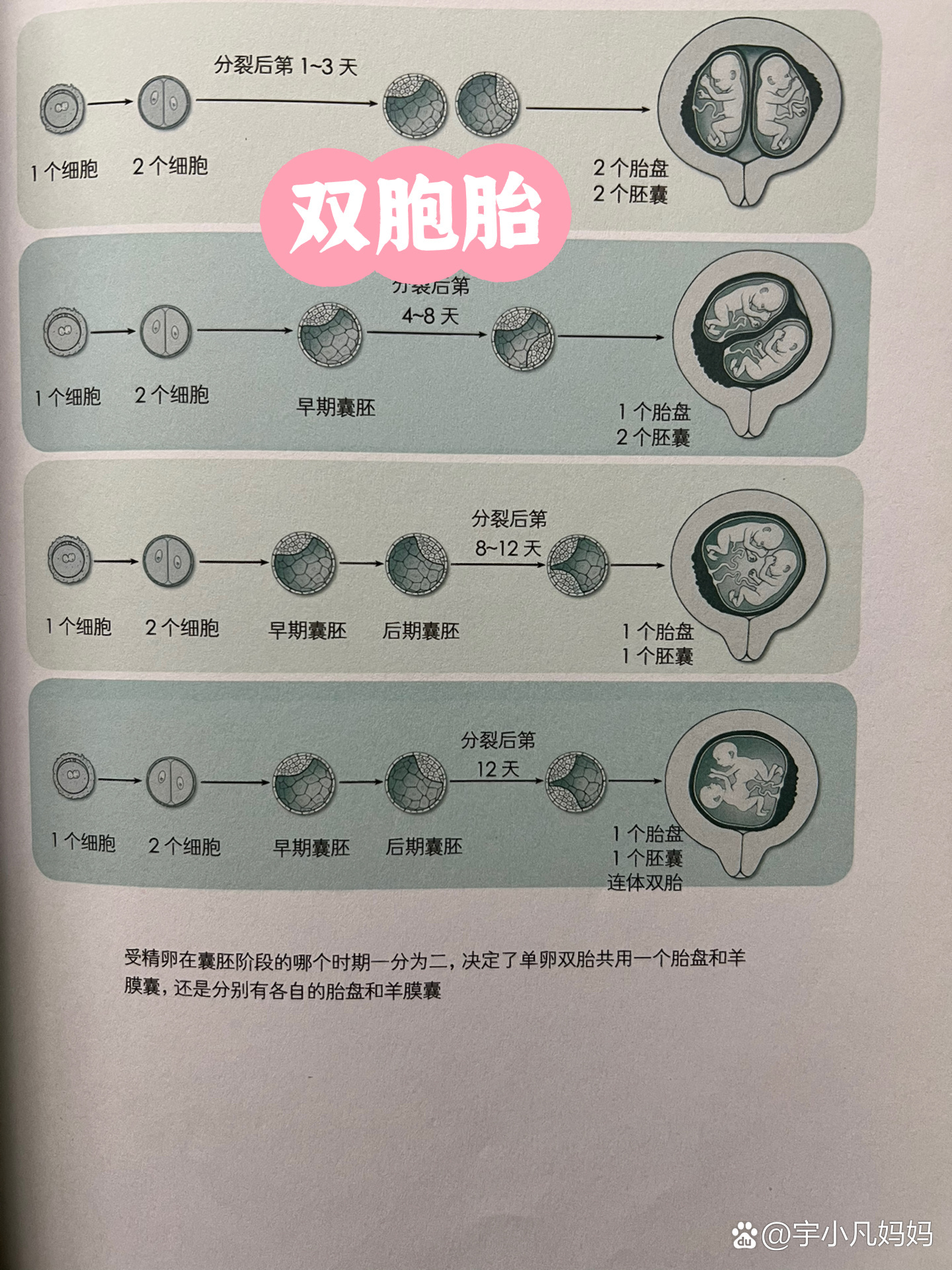 双胞胎胎盘图片图片